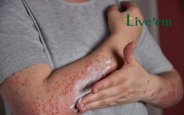 psoriasis treatment