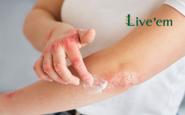 psoriasis treatment
