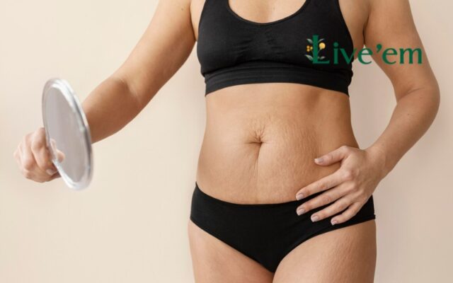 stretch mark treatment