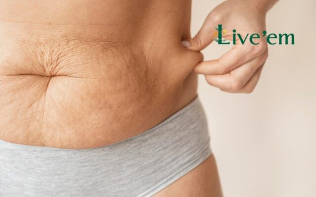 stretch mark treatment